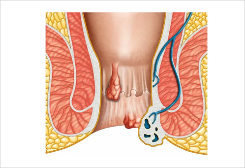 Piles Surgery