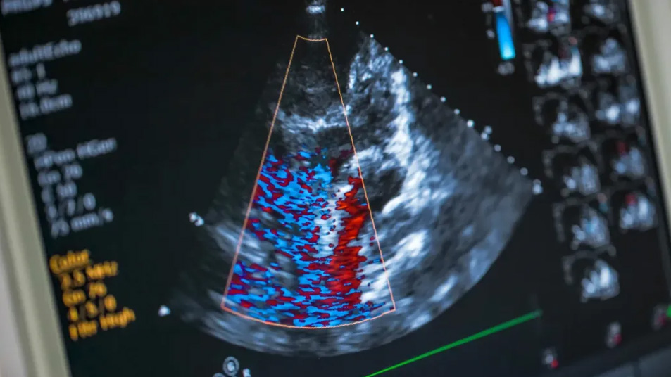 Echo Cardiography (2D Echo)