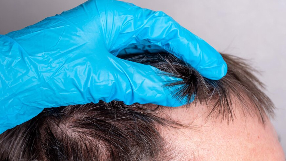 Mesotherapy For Hair Loss Treatment